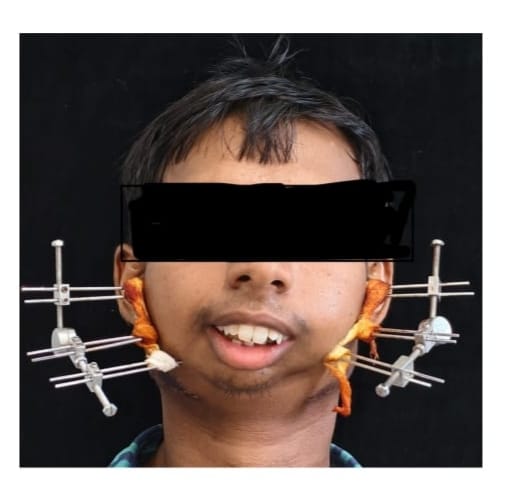 सिम्स में 24 वर्षीय युवक के बचपन से बंद जबड़े का सफल ऑपरेशन….जटिल सर्जरी से खुला मुंह, आयुष्मान योजना से मिला निःशुल्क उपचार